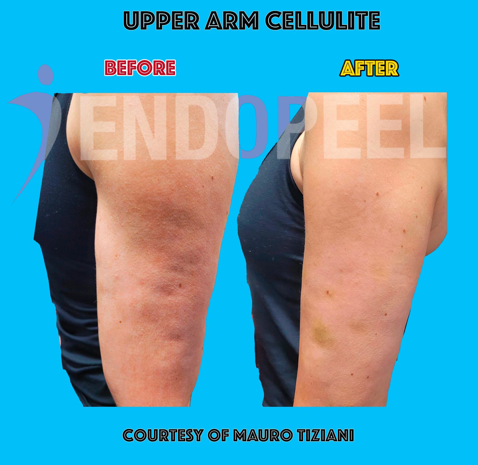 upper-arm-cellulite.