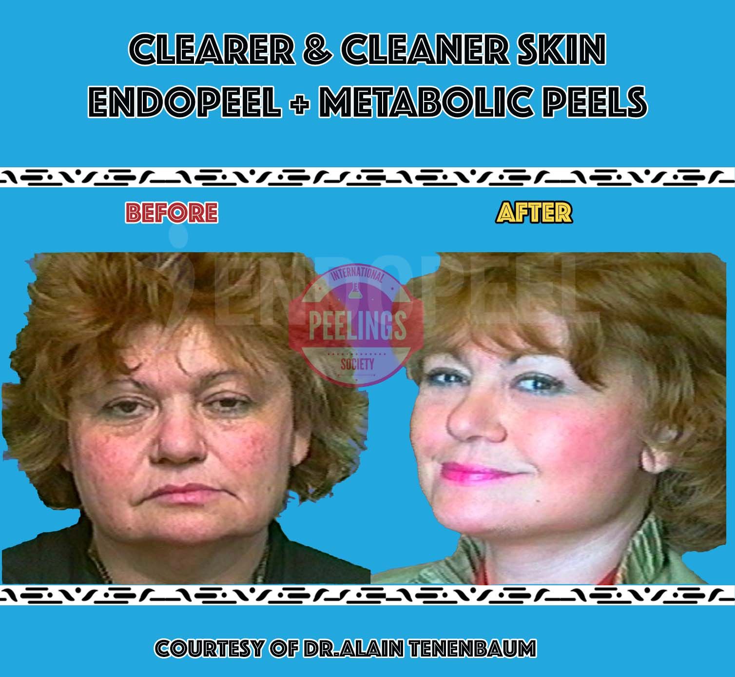 clearer and cleaner skin after endopeel + metabolic peels