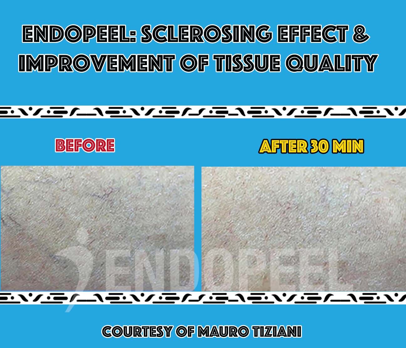 endopeel-sclerotherapy