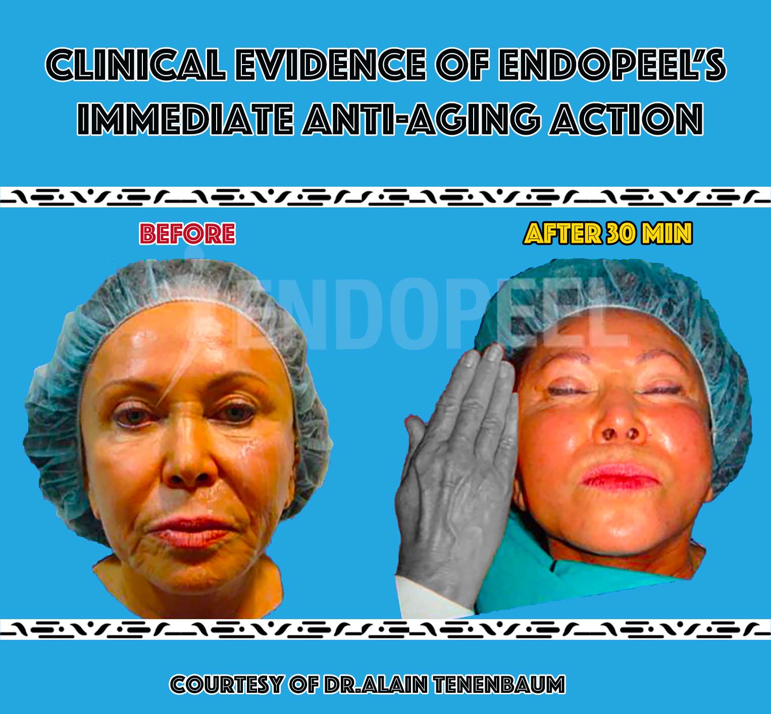 antiaging-indication-endopeel