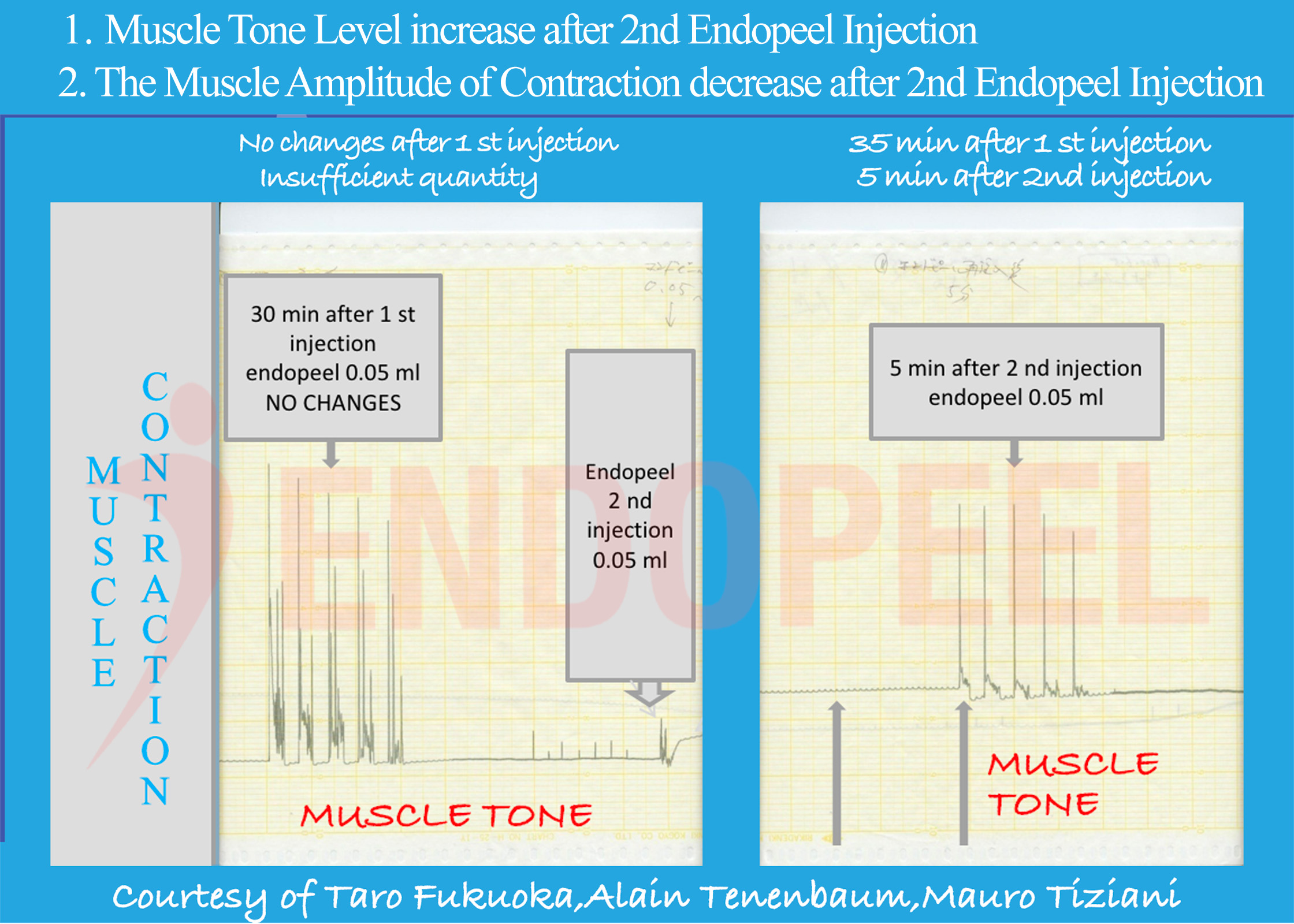 Muscle tracing following second Endopeel® injection demonstrating reinforced myotension and structural stabilization