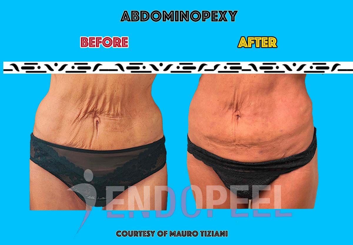 abdominoplasty