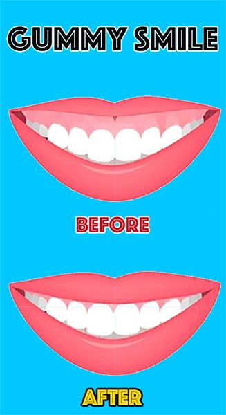 gummy-smile
